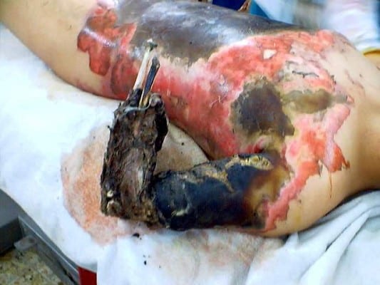 An example of incendiary bomb wounds. 